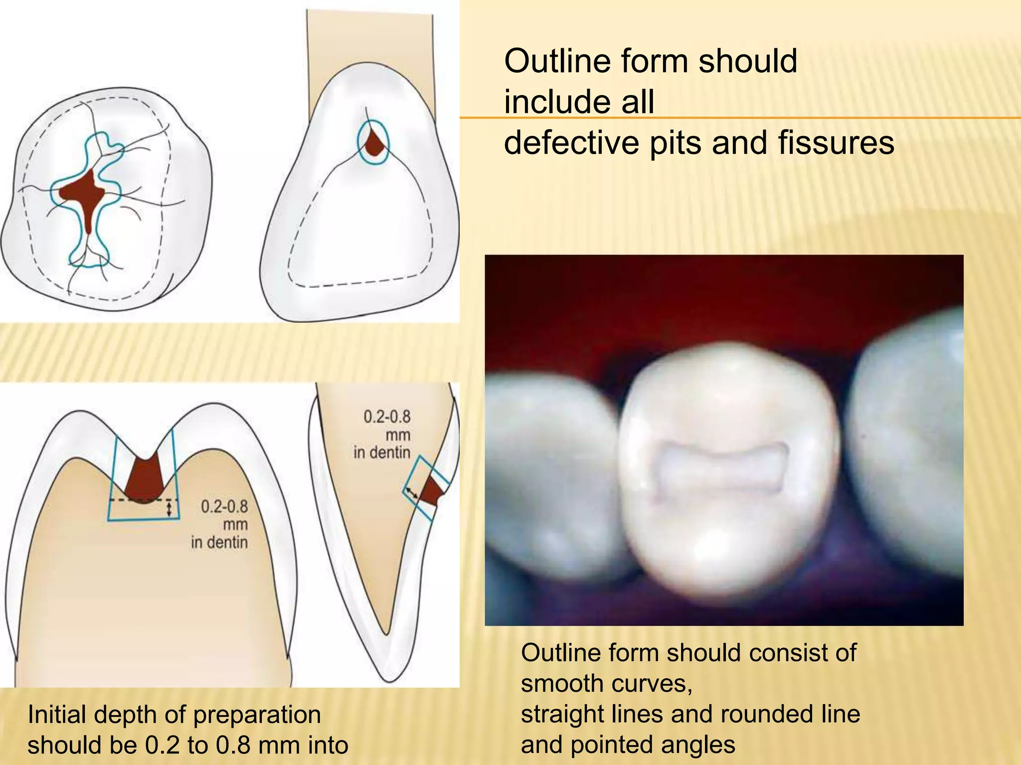 Outline form should
include all
defective pits and fissures

Initial depth of preparation
should be 0.2 to 0.8 mm into

Outline form should consist of
smooth curves,
straight lines and rounded line
and pointed angles

 