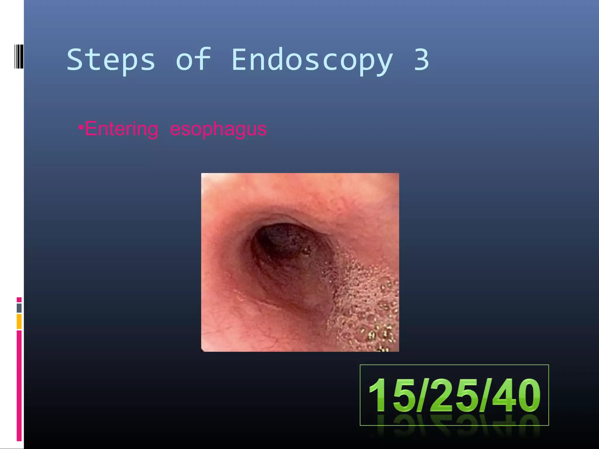 Steps of Endoscopy 3
•Entering esophagus
 