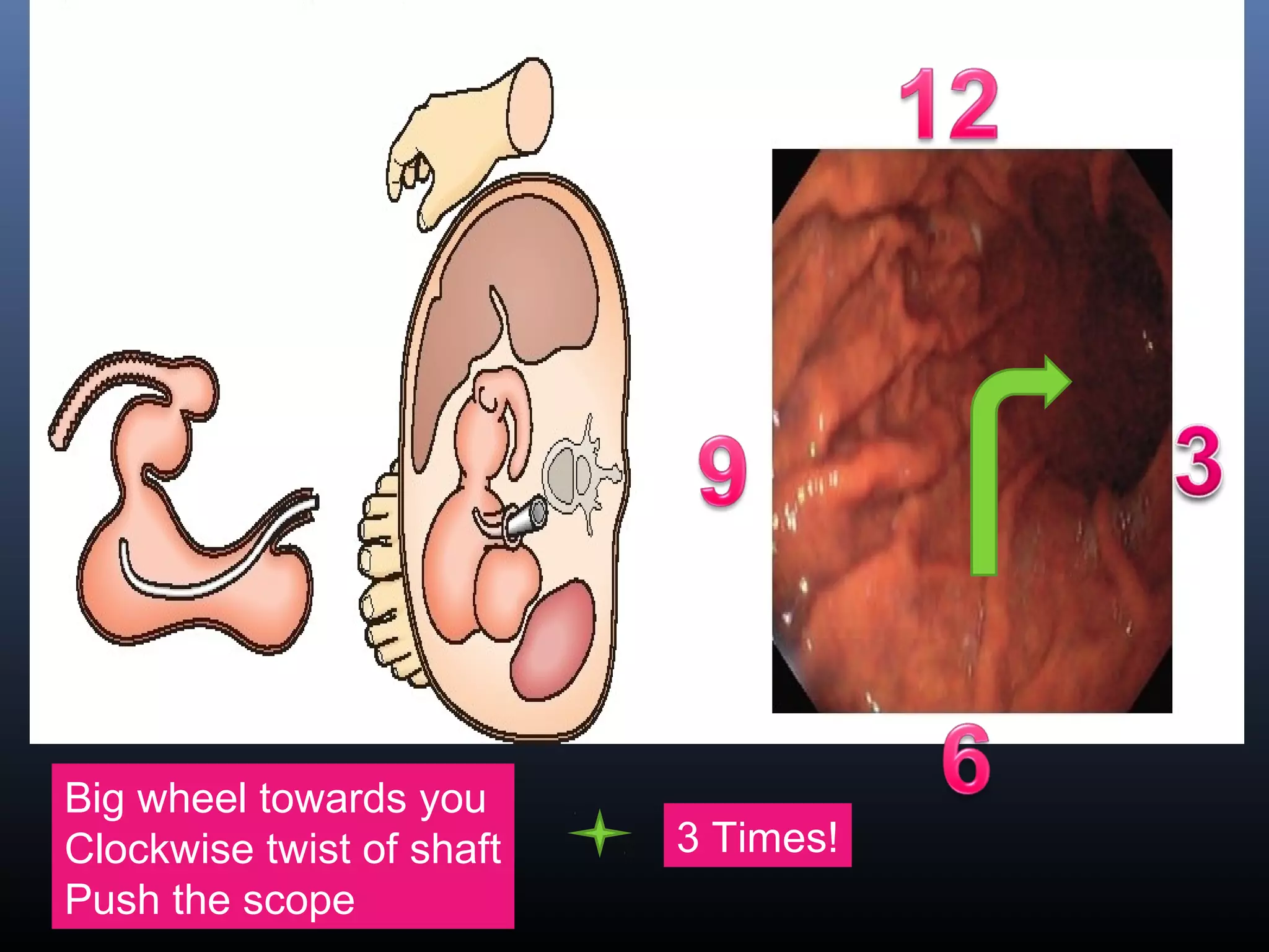 Big wheel towards you
Clockwise twist of shaft
Push the scope
3 Times!
 