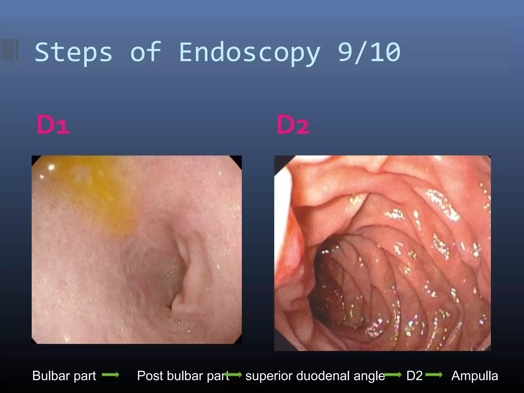 Steps of Endoscopy 9/10
D1 D2
Bulbar part Post bulbar part superior duodenal angle D2 Ampulla
 