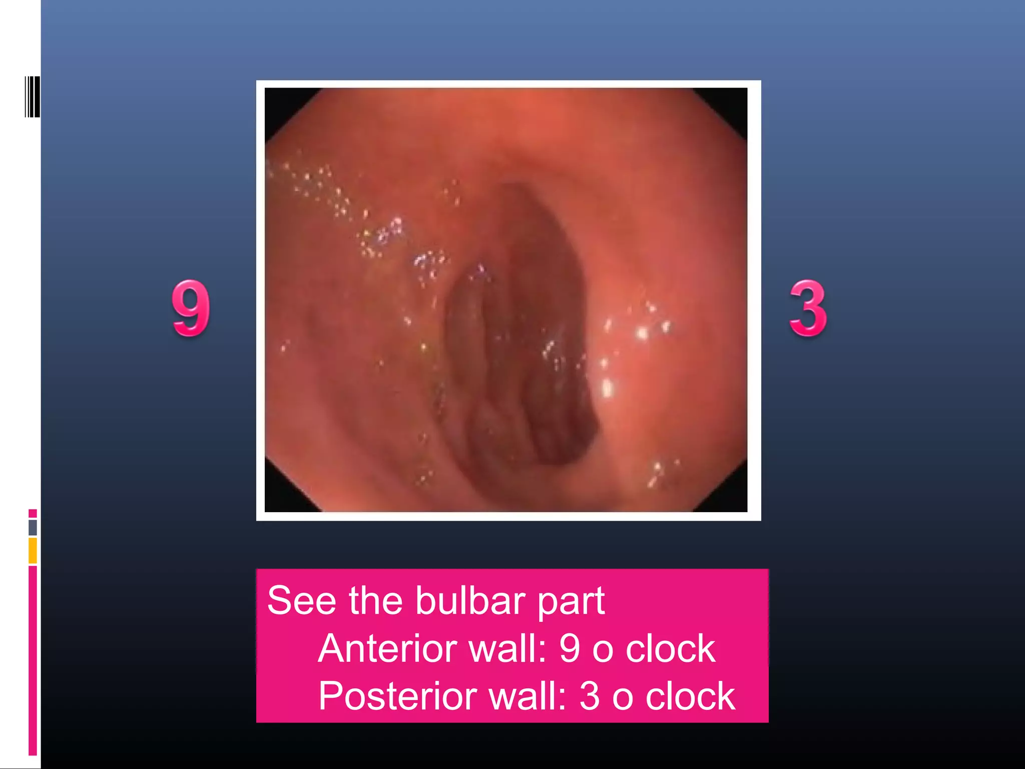 See the bulbar part
Anterior wall: 9 o clock
Posterior wall: 3 o clock
 