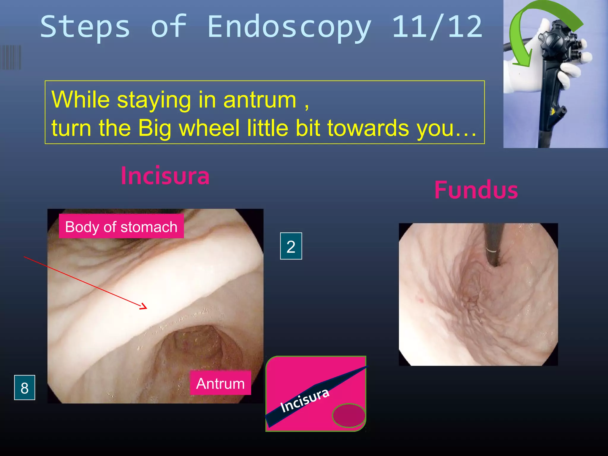 Steps of Endoscopy 11/12
Incisura
Fundus
Antrum
Body of stomach
8
2
While staying in antrum ,
turn the Big wheel little bit towards you…
Incisura
 