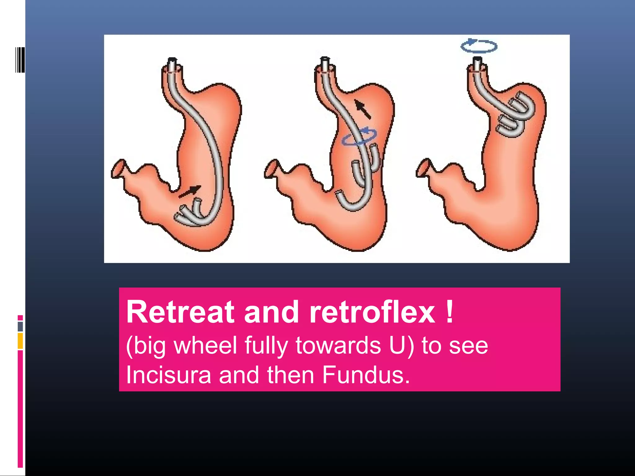 Retreat and retroflex !
(big wheel fully towards U) to see
Incisura and then Fundus.
 