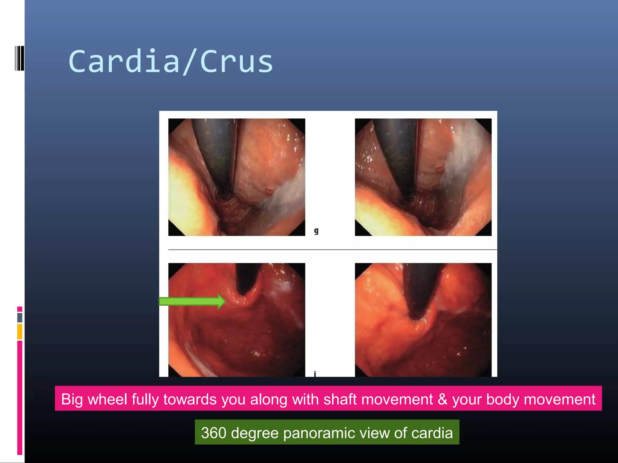 Cardia/Crus
Big wheel fully towards you along with shaft movement & your body movement
360 degree panoramic view of cardia
 