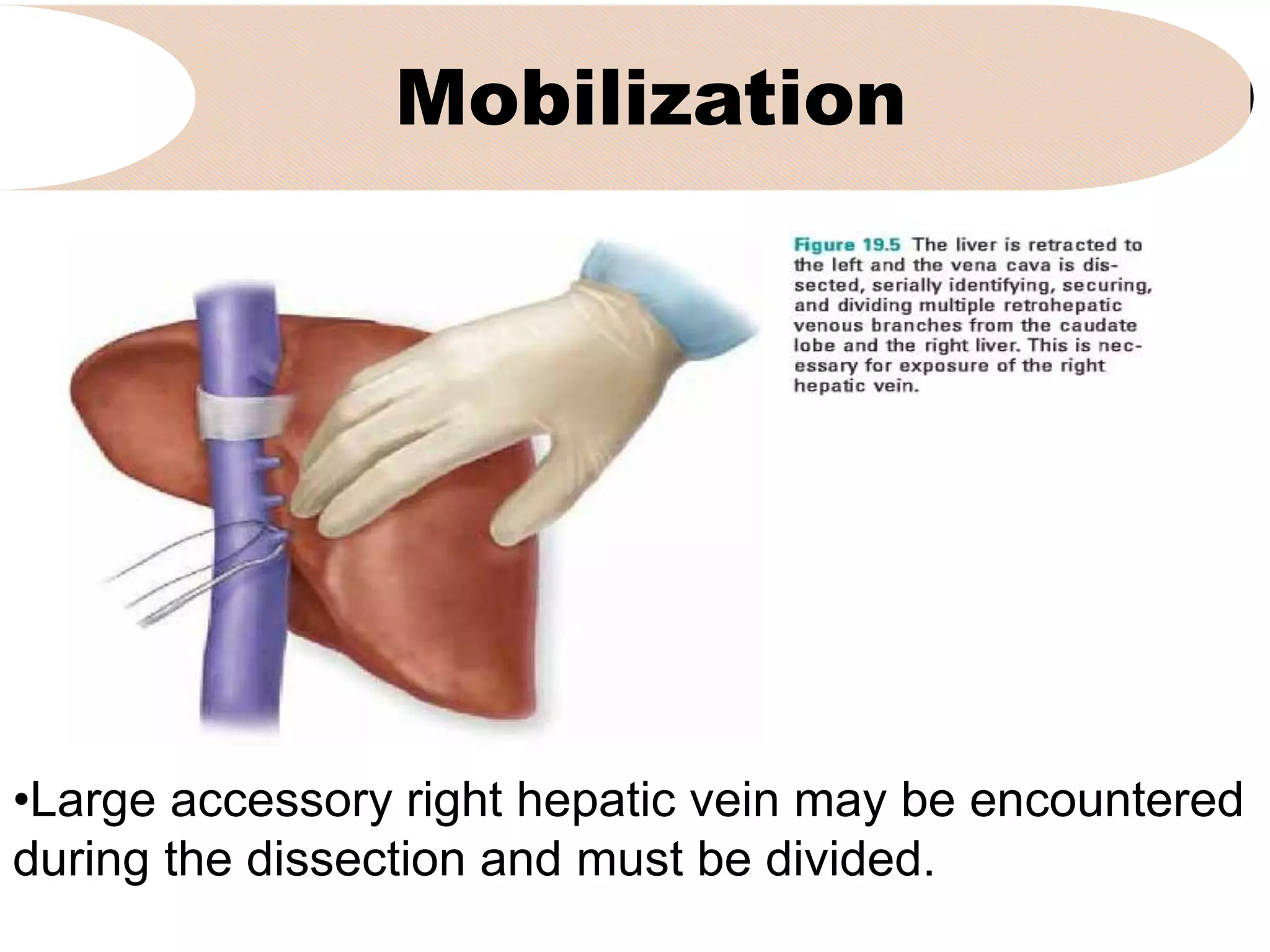 Mobilization
•Large accessory right hepatic vein may be encountered
during the dissection and must be divided.
 