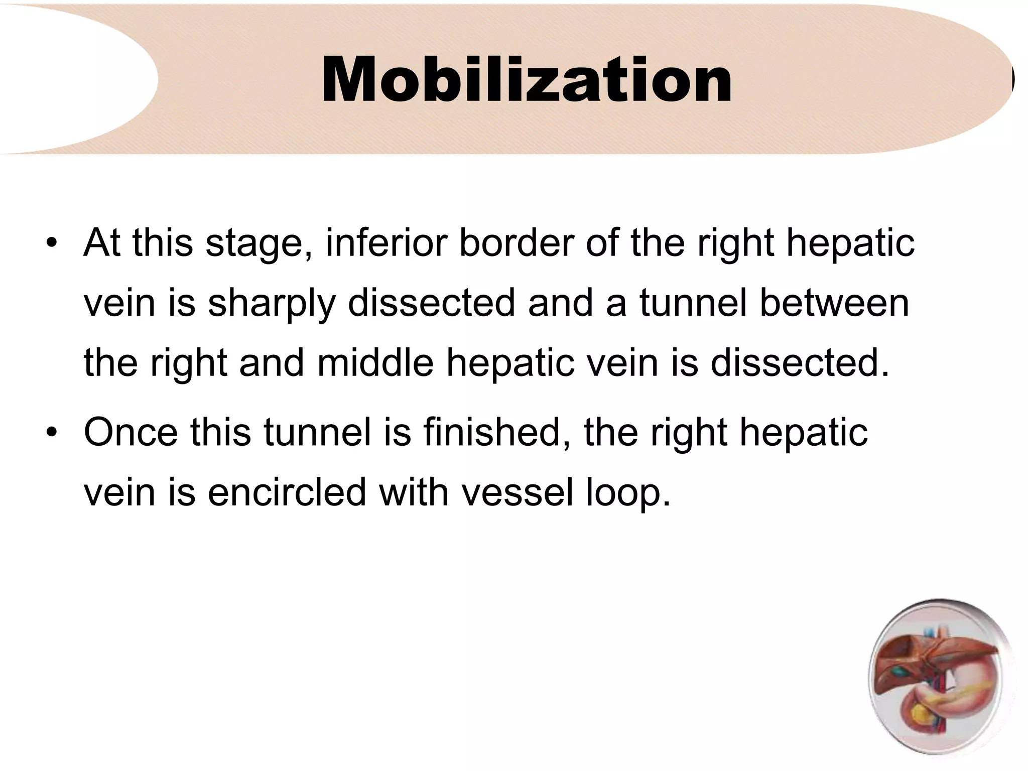 Mobilization
• At this stage, inferior border of the right hepatic
vein is sharply dissected and a tunnel between
the right and middle hepatic vein is dissected.
• Once this tunnel is finished, the right hepatic
vein is encircled with vessel loop.
 
