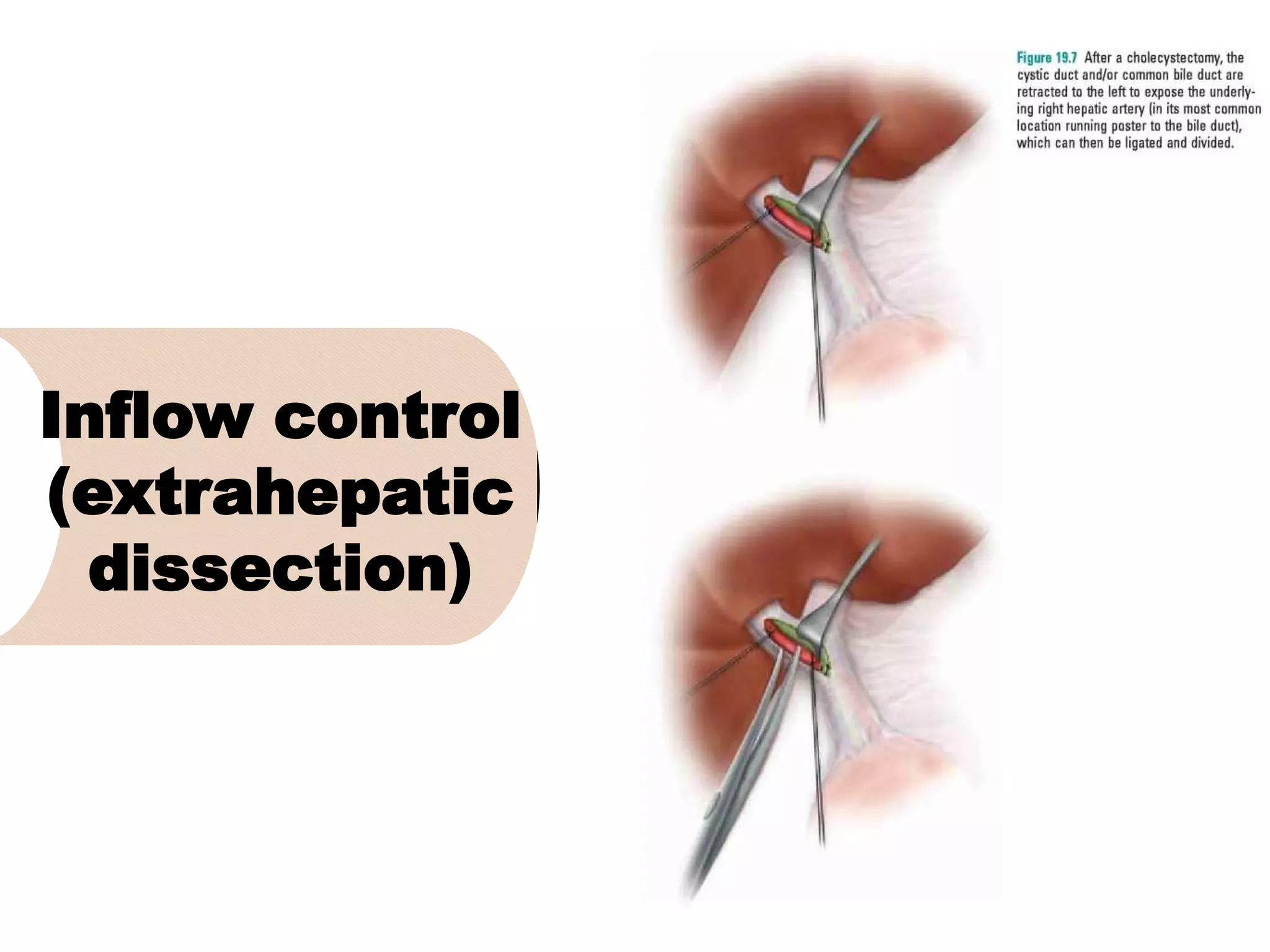 Inflow control
(extrahepatic
dissection)
 