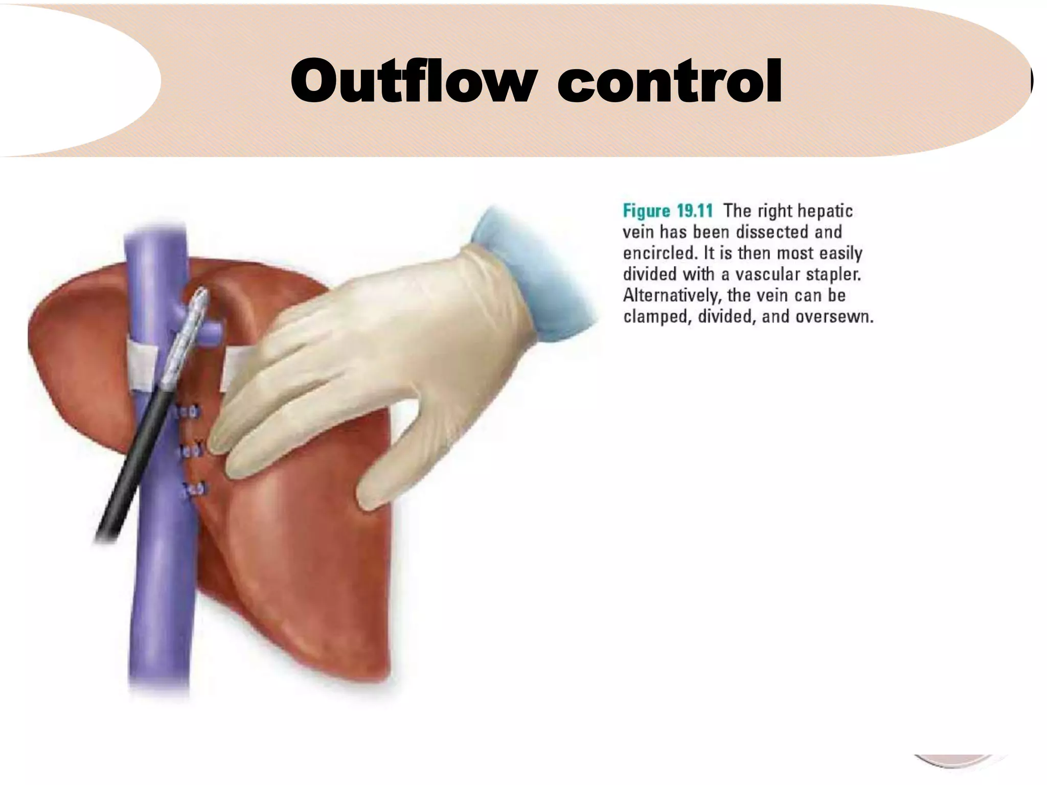 Outflow control
•
 