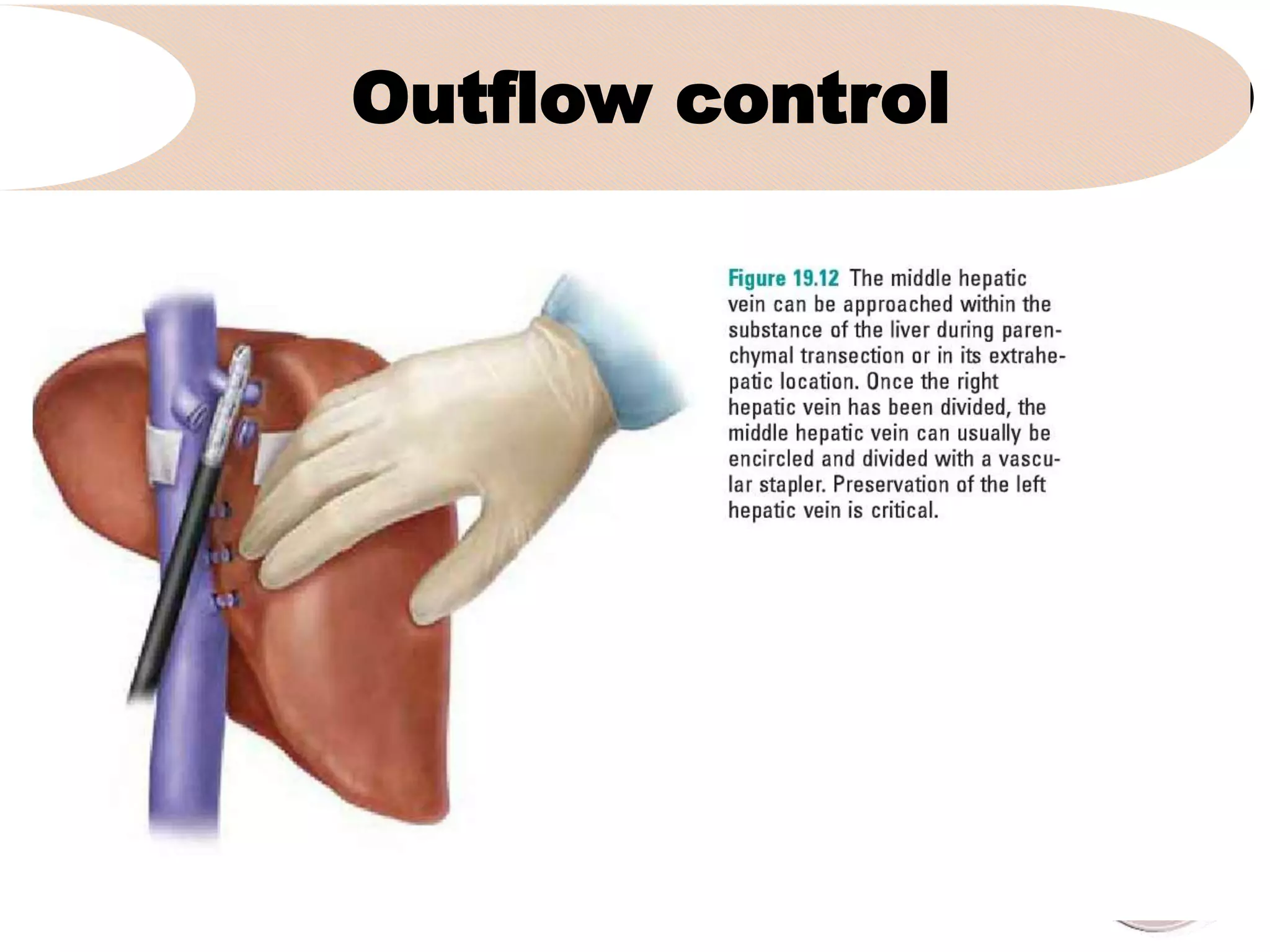Outflow control
•
 