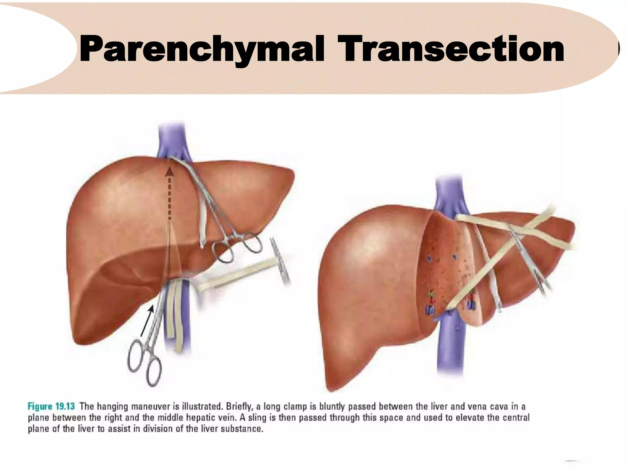 Parenchymal Transection
•
 