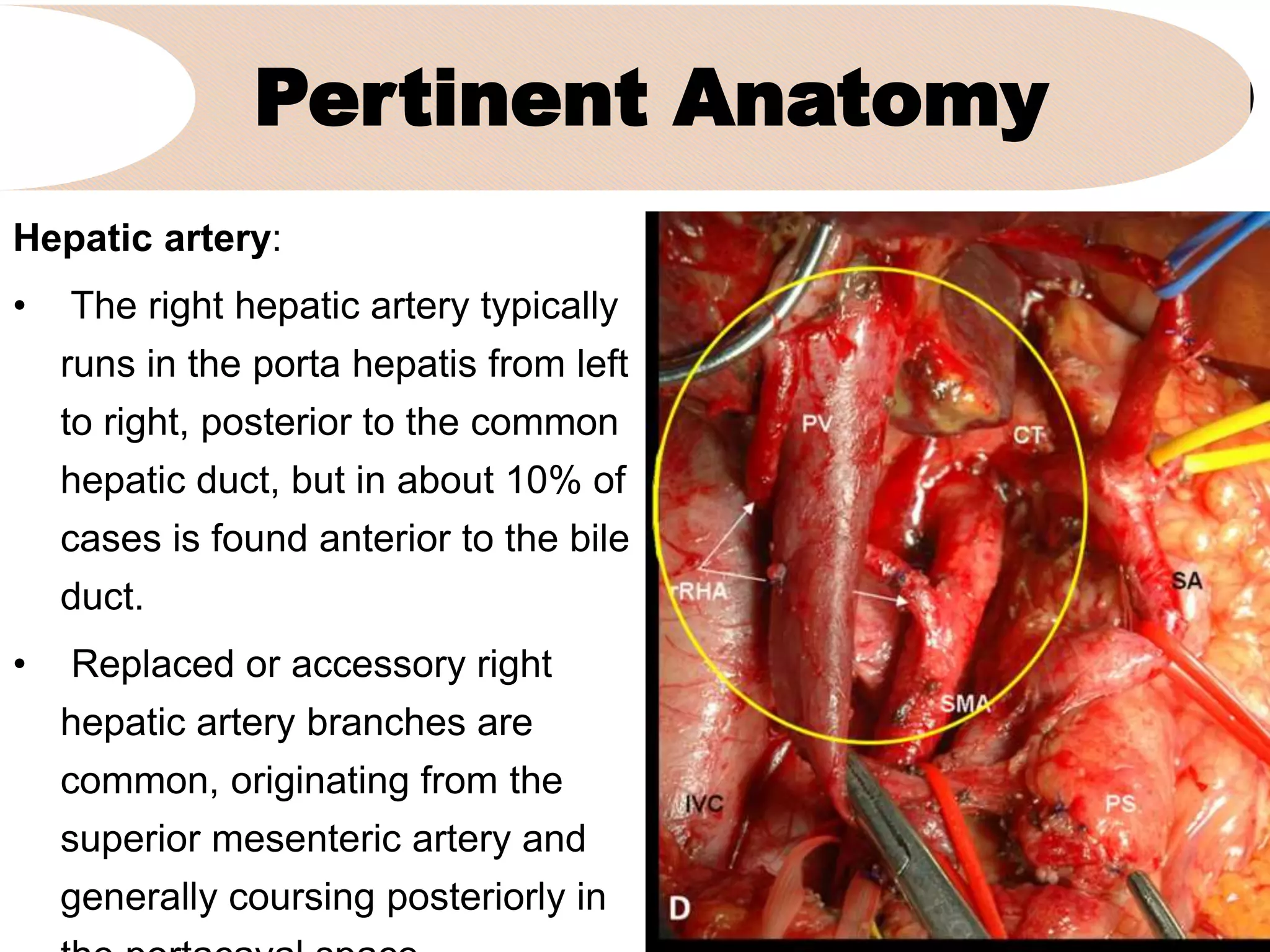 Pertinent Anatomy
Hepatic artery:
• The right hepatic artery typically
runs in the porta hepatis from left
to right, posterior to the common
hepatic duct, but in about 10% of
cases is found anterior to the bile
duct.
• Replaced or accessory right
hepatic artery branches are
common, originating from the
superior mesenteric artery and
generally coursing posteriorly in
 