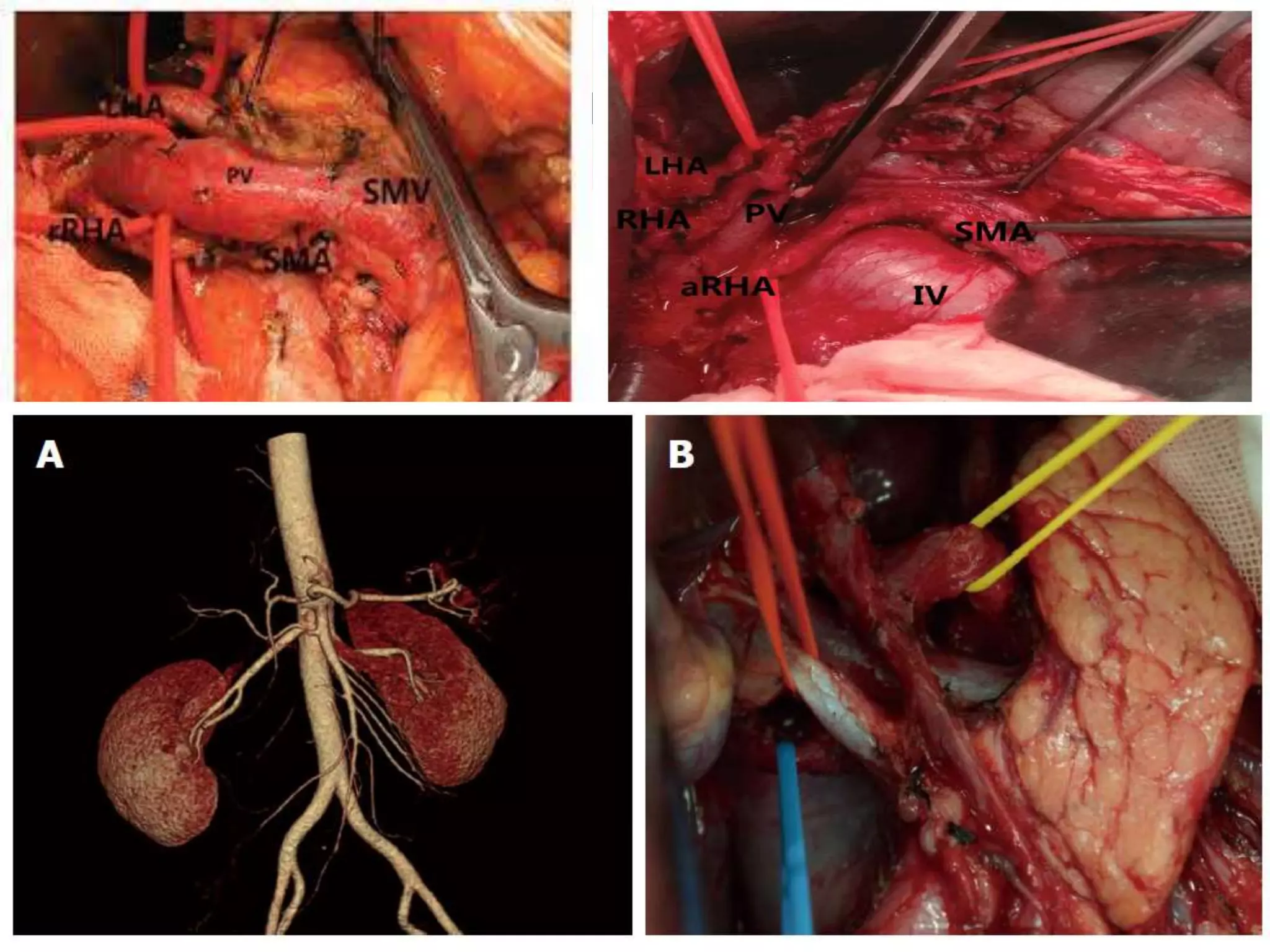 Pertinent Anatomy
Hepatic artery:
 