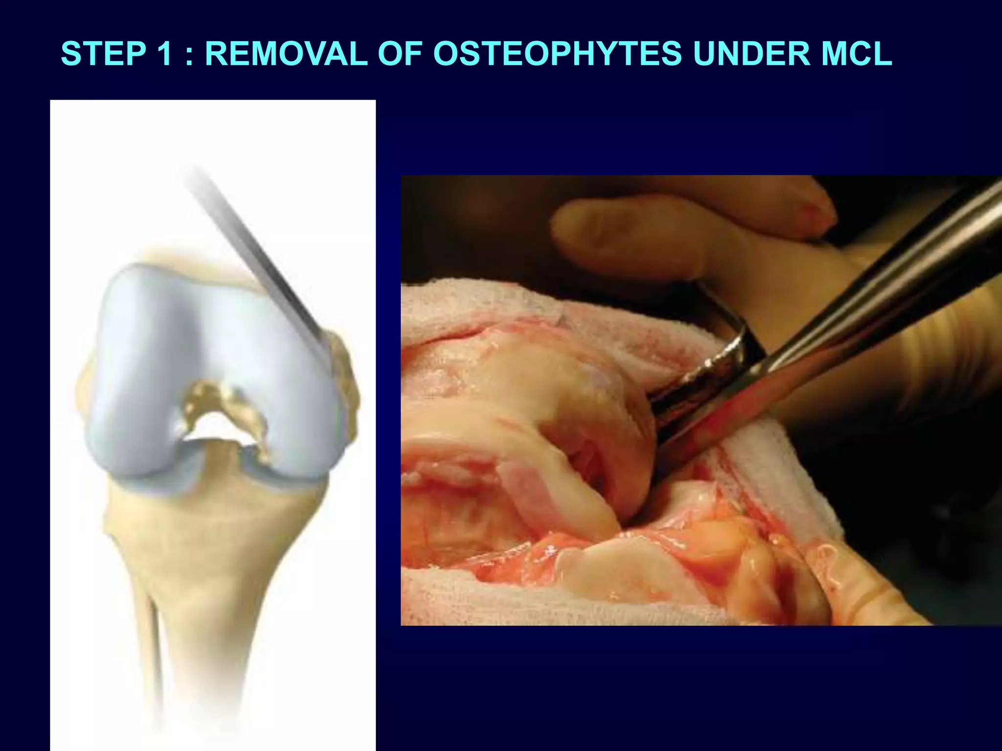 STEP 1 : REMOVAL OF OSTEOPHYTES UNDER MCL
 