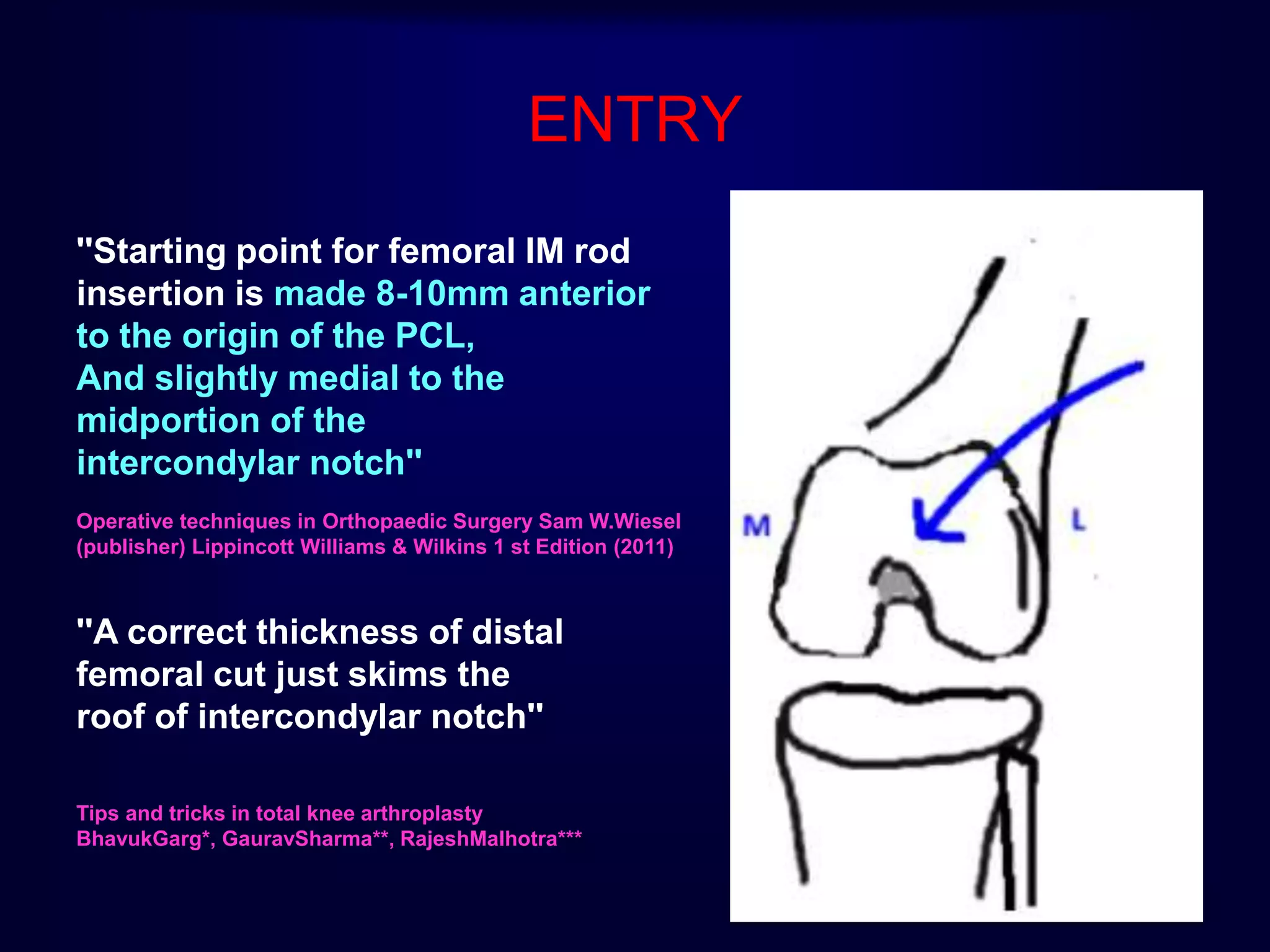 ENTRY
''Starting point for femoral IM rod
insertion is made 8-10mm anterior
to the origin of the PCL,
And slightly medial to the
midportion of the
intercondylar notch''
''A correct thickness of distal
femoral cut just skims the
roof of intercondylar notch''
Operative techniques in Orthopaedic Surgery Sam W.Wiesel
(publisher) Lippincott Williams & Wilkins 1 st Edition (2011)
Tips and tricks in total knee arthroplasty
BhavukGarg*, GauravSharma**, RajeshMalhotra***
 