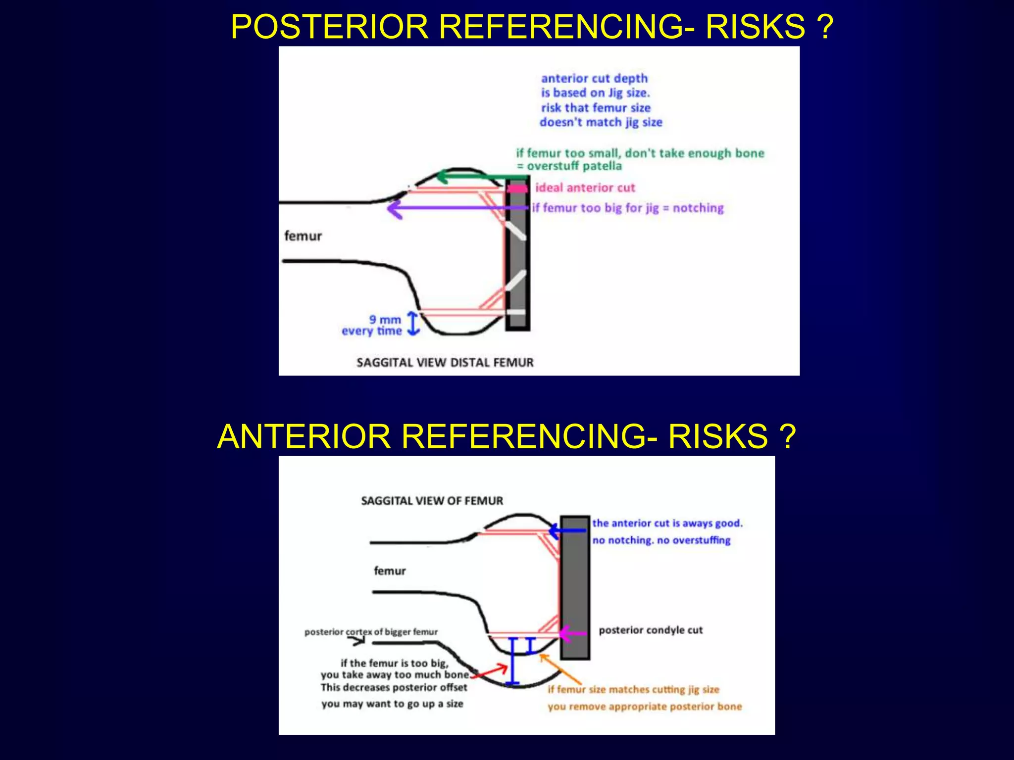 POSTERIOR REFERENCING- RISKS ?
ANTERIOR REFERENCING- RISKS ?
 
