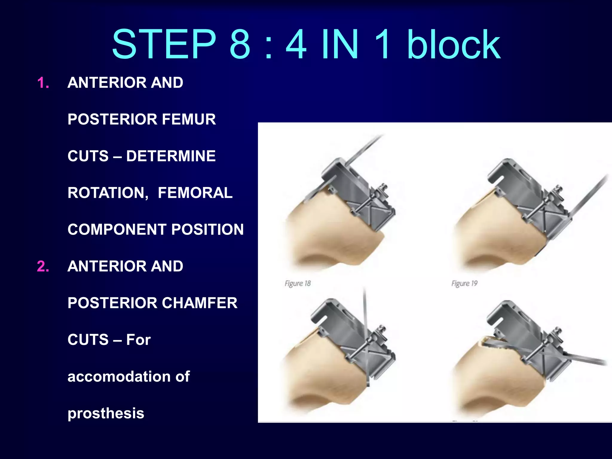 STEP 8 : 4 IN 1 block
1. ANTERIOR AND
POSTERIOR FEMUR
CUTS – DETERMINE
ROTATION, FEMORAL
COMPONENT POSITION
2. ANTERIOR AND
POSTERIOR CHAMFER
CUTS – For
accomodation of
prosthesis
 