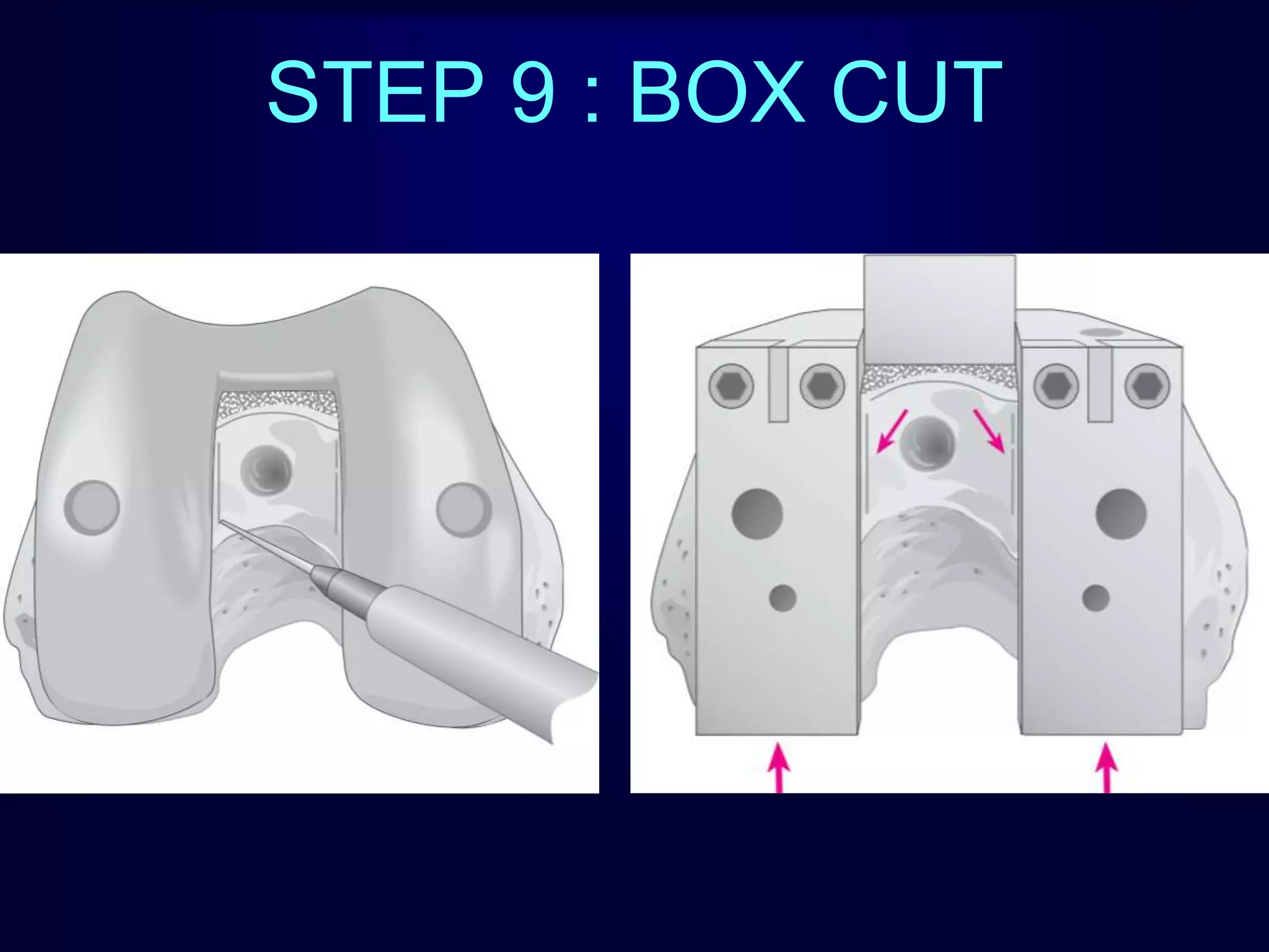 STEP 9 : BOX CUT
 