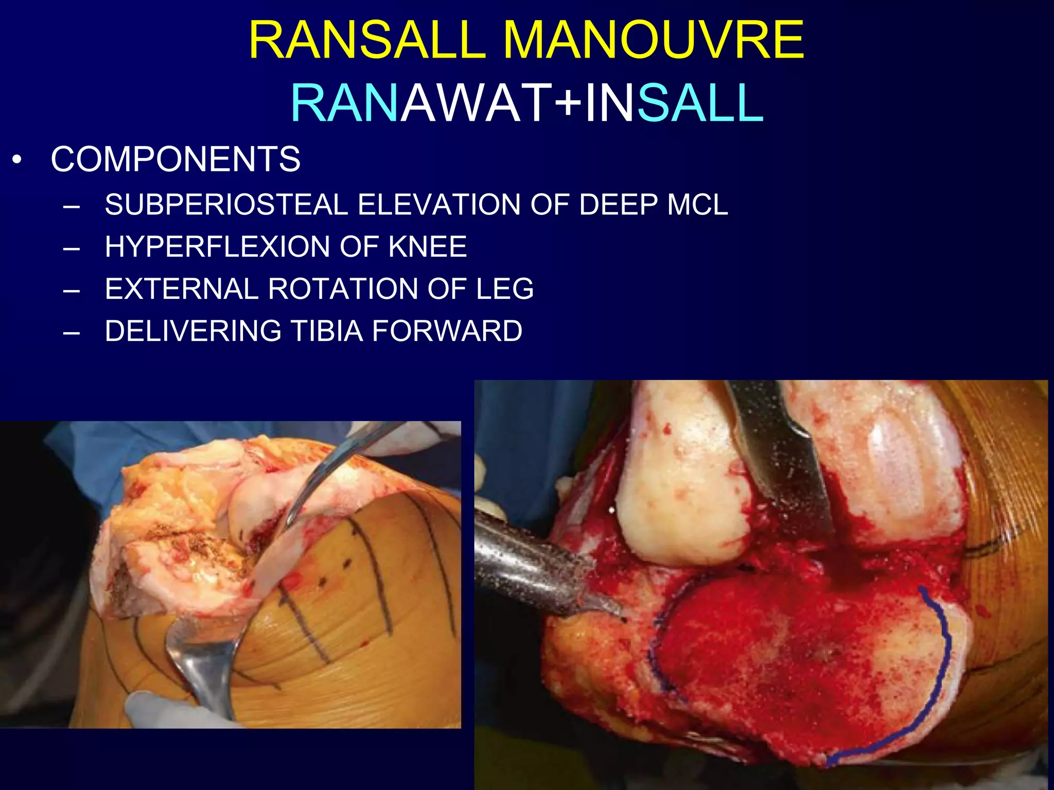 • COMPONENTS
– SUBPERIOSTEAL ELEVATION OF DEEP MCL
– HYPERFLEXION OF KNEE
– EXTERNAL ROTATION OF LEG
– DELIVERING TIBIA FORWARD
RANSALL MANOUVRE
RANAWAT+INSALL
 