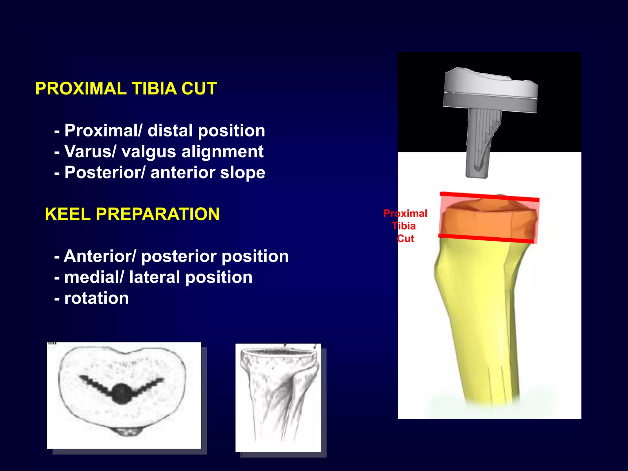 PROXIMAL TIBIA CUT
- Proximal/ distal position
- Varus/ valgus alignment
- Posterior/ anterior slope
KEEL PREPARATION
- Anterior/ posterior position
- medial/ lateral position
- rotation
Proximal
Tibia
Cut
 
