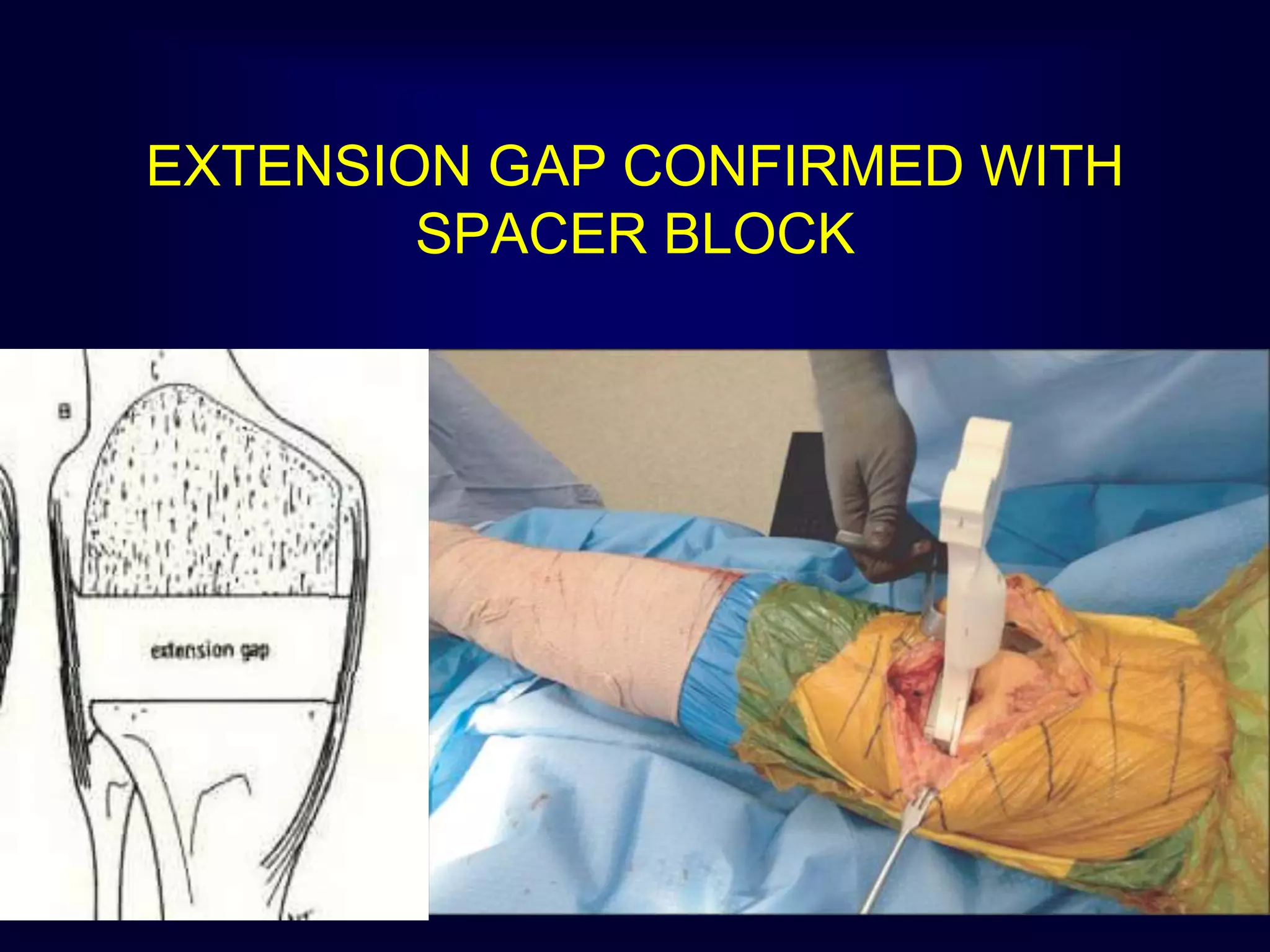 EXTENSION GAP CONFIRMED WITH
SPACER BLOCK
 