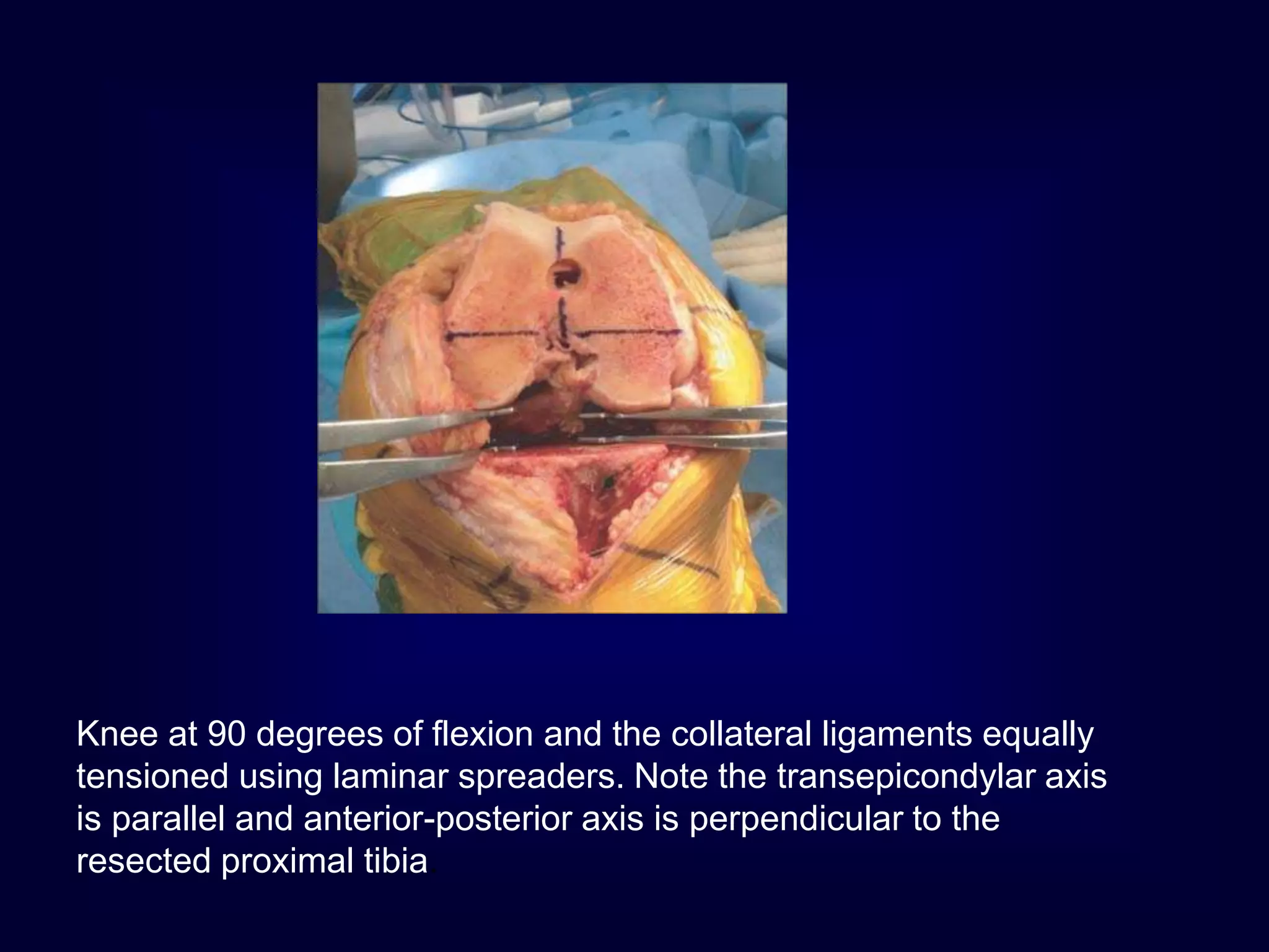 Knee at 90 degrees of flexion and the collateral ligaments equally
tensioned using laminar spreaders. Note the transepicondylar axis
is parallel and anterior-posterior axis is perpendicular to the
resected proximal tibia.
 