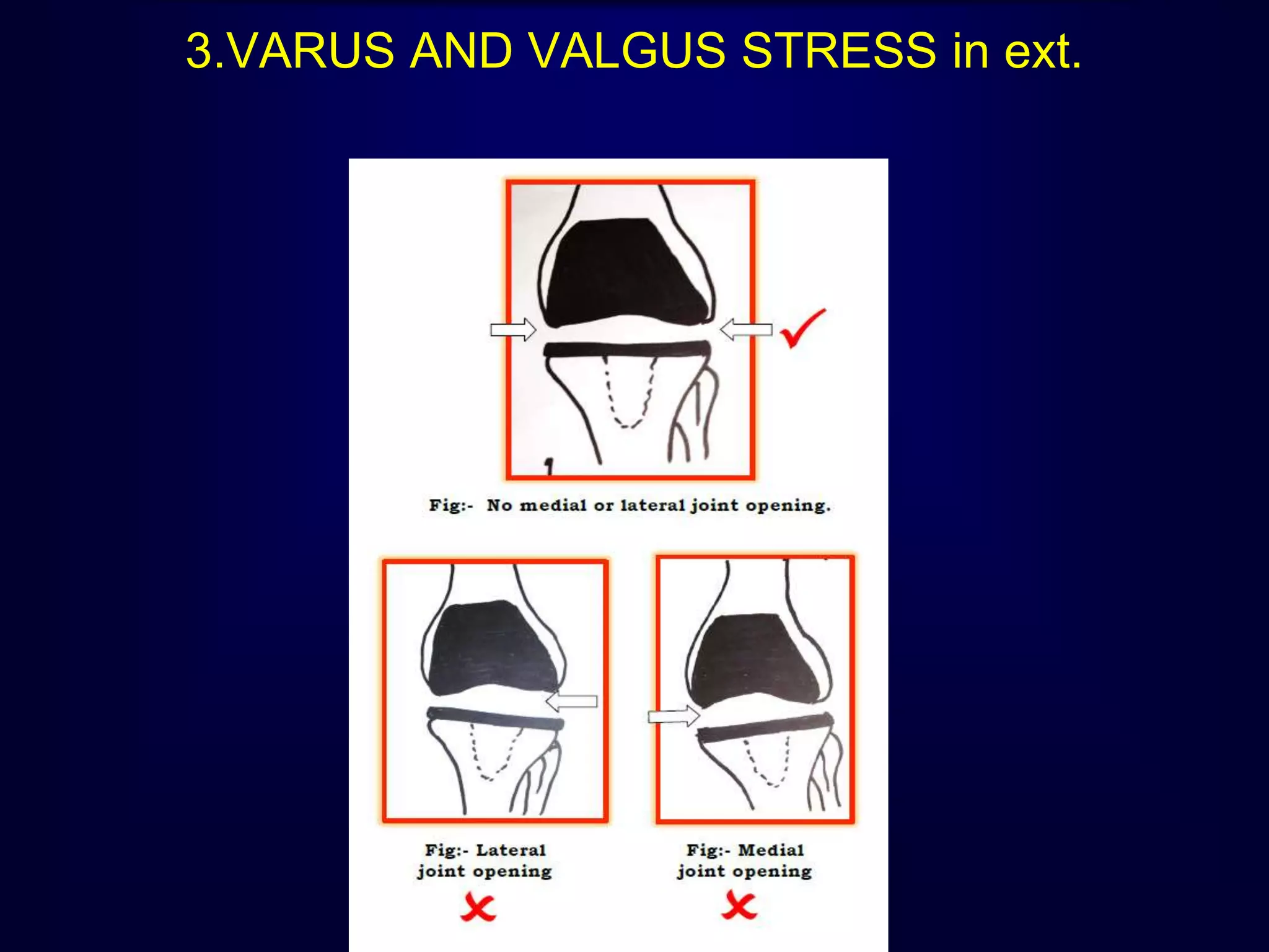 3.VARUS AND VALGUS STRESS in ext.
 