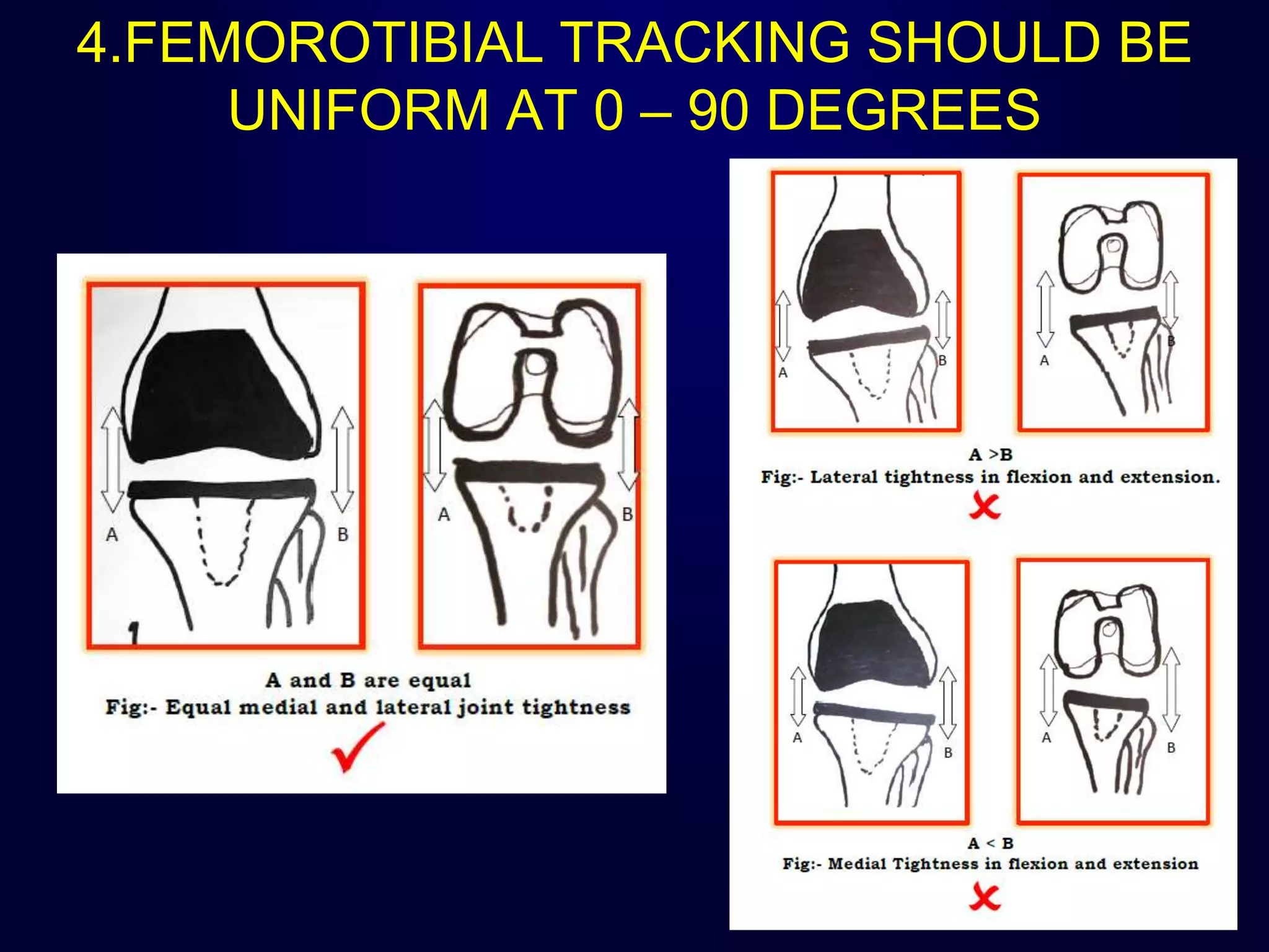 4.FEMOROTIBIAL TRACKING SHOULD BE
UNIFORM AT 0 – 90 DEGREES
 