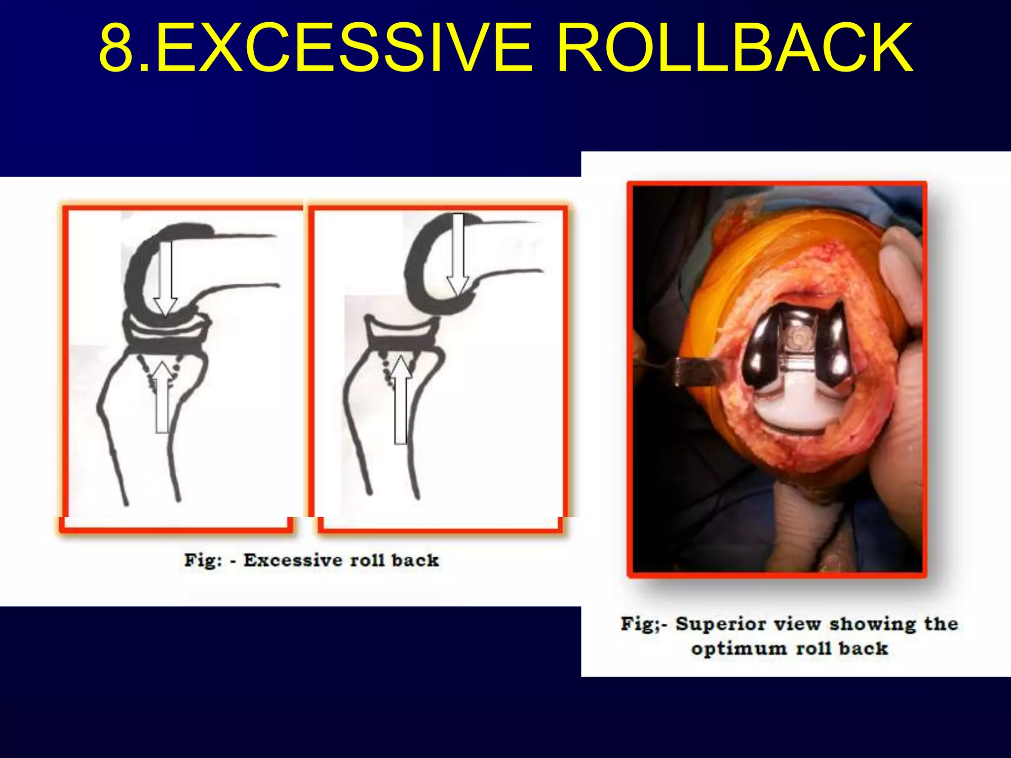 8.EXCESSIVE ROLLBACK
 