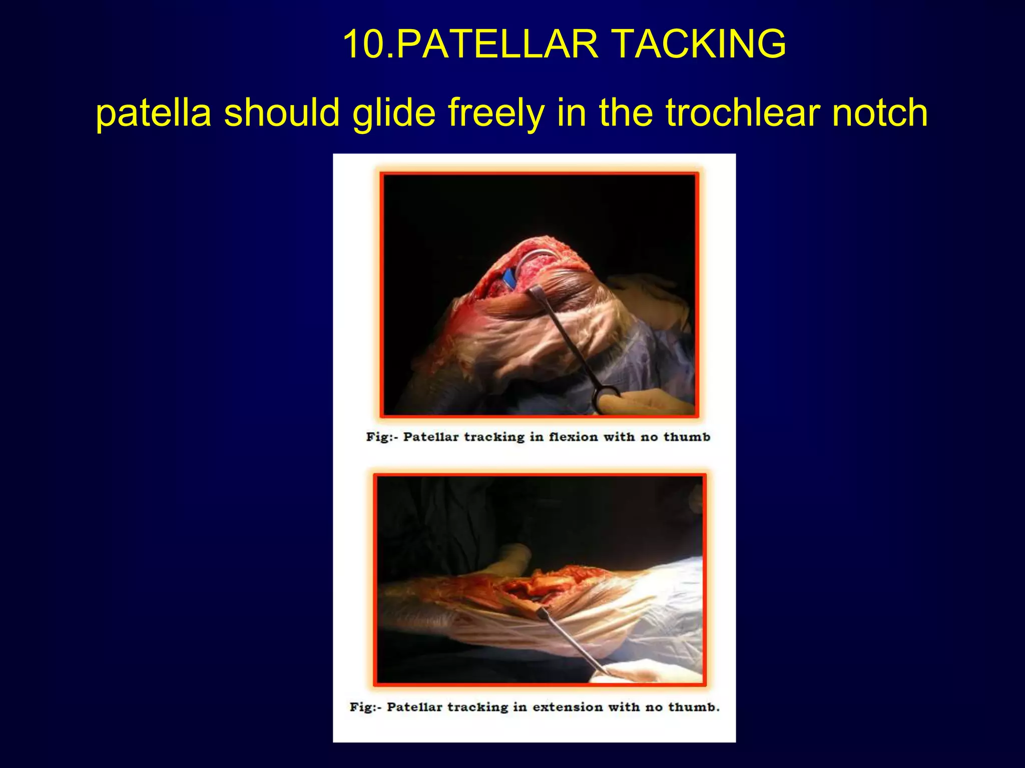 10.PATELLAR TACKING
patella should glide freely in the trochlear notch
 