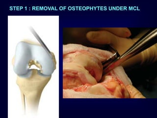 STEP 1 : REMOVAL OF OSTEOPHYTES UNDER MCL
 