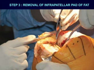 STEP 3 : REMOVAL OF INFRAPATELLAR PAD OF FAT
 