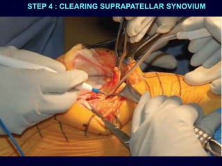 STEP 4 : CLEARING SUPRAPATELLAR SYNOVIUM
 