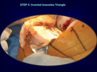 STEP 5- Inverted Isosceles Triangle
 