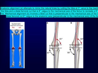 Anatomic alignment (a) attempts to mimic the natural knee by cutting the tibia at 3° varus to the mech
f the tibia and a distal femoral cut that is 9° valgus to the mechanical axis of the femur to recreate a 6°
line. Mechanical alignment (b) involves a tibial cut that is perpendicular to the mechanical axis of the ti
distal femoral cut 6° valgus to the anatomic axis (perpendicular to the mechanical axis) of the fem
 