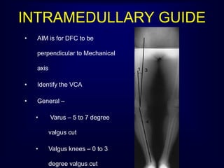 INTRAMEDULLARY GUIDE
• AIM is for DFC to be
perpendicular to Mechanical
axis
• Identify the VCA
• General –
• Varus – 5 to 7 degree
valgus cut
• Valgus knees – 0 to 3
degree valgus cut
 