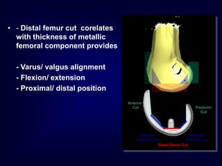 Distal Femur Cut
Anterior
Chamfer Cut
Posterior
Cut
Anterior
Cut
Posterior
Chamfer Cut
• - Distal femur cut corelates
with thickness of metallic
femoral component provides
- Varus/ valgus alignment
- Flexion/ extension
- Proximal/ distal position
 
