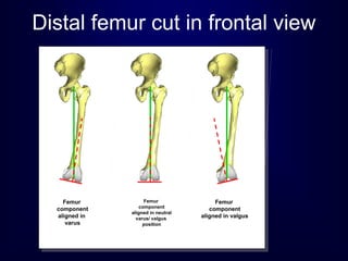 Femur
component
aligned in
varus
Femur
component
aligned in valgus
Femur
component
aligned in neutral
varus/ valgus
position
Distal femur cut in frontal view
 