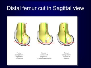 Femur
component
aligned in
extension
Femur
component
aligned in
flexion
Femur
component
aligned in
0° flexion/ extension
Distal femur cut in Sagittal view
 