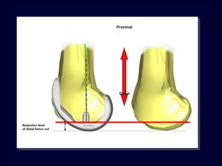 Proximal
Distal
Resection level
of distal femur cut
 