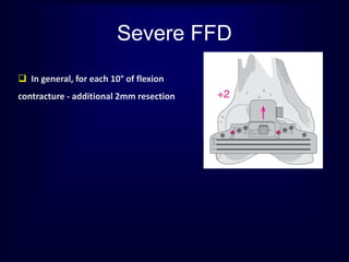  In general, for each 10° of flexion
contracture - additional 2mm resection
Severe FFD
 