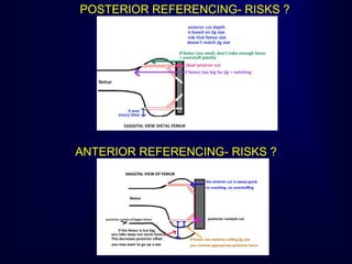 POSTERIOR REFERENCING- RISKS ?
ANTERIOR REFERENCING- RISKS ?
 
