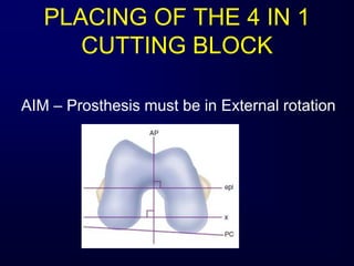 PLACING OF THE 4 IN 1
CUTTING BLOCK
AIM – Prosthesis must be in External rotation
 