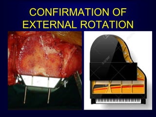 CONFIRMATION OF
EXTERNAL ROTATION
 