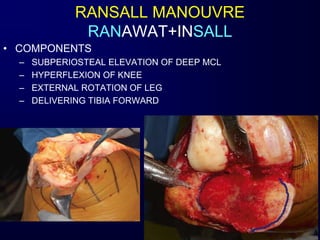 • COMPONENTS
– SUBPERIOSTEAL ELEVATION OF DEEP MCL
– HYPERFLEXION OF KNEE
– EXTERNAL ROTATION OF LEG
– DELIVERING TIBIA FORWARD
RANSALL MANOUVRE
RANAWAT+INSALL
 