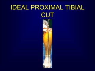 IDEAL PROXIMAL TIBIAL
CUT
 