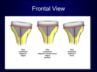 Tibia
component
aligned in
valgus
Tibia
component
aligned in neutral varus/
valgus
position
Tibia
component
aligned in
varus
Frontal View
 