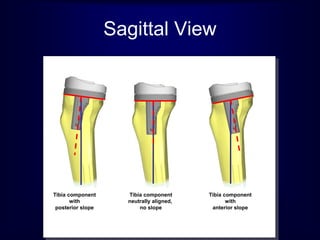 Tibia component
with
posterior slope
Tibia component
neutrally aligned,
no slope
Tibia component
with
anterior slope
Sagittal View
 