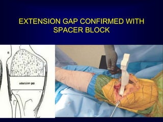 EXTENSION GAP CONFIRMED WITH
SPACER BLOCK
 