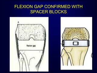 FLEXION GAP CONFIRMED WITH
SPACER BLOCKS
 