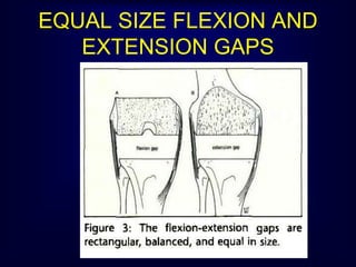 EQUAL SIZE FLEXION AND
EXTENSION GAPS
 